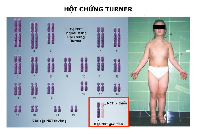 Hội chứng Turner có thể sàng lọc với xét nghiệm NIPT