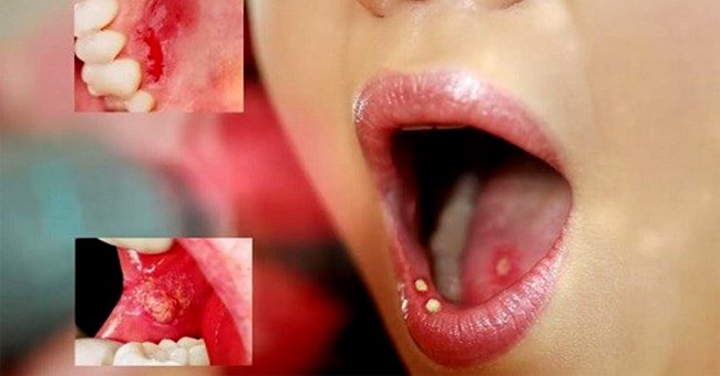 Vết loét, vết thương, vết phồng rộp, vết loét có thể là biểu hiện của ung thư môi