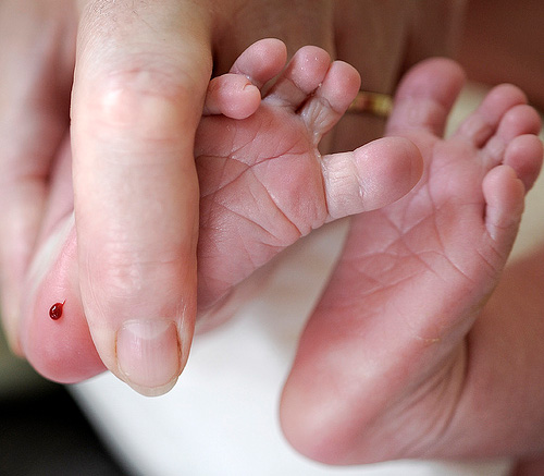 Sàng lọc sơ sinh được tiến hành bằng cách lấy 2 giọt máu ở gót chân bé