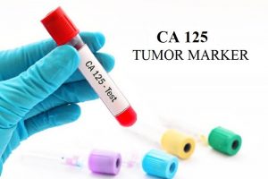 Hiểu đúng về Tumor marker – Dấu ấn ung thư 