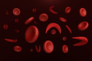 10 biến chứng nguy hiểm của bệnh hồng cầu hình liềm