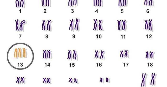 Hội chứng Patau là sự bất thường nhiễm sắc thể số 13
