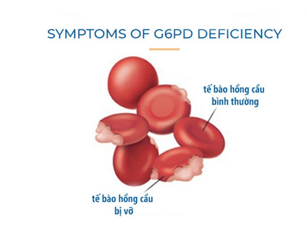 Sàng lọc sơ sinh phát hiện được bệnh thiếu men G6PD