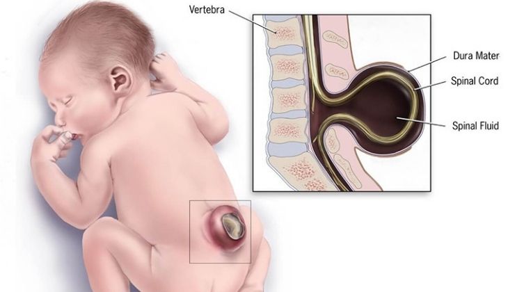 Dị tật bẩm sinh nứt đốt sống ở trẻ là một dạng khuyết tật của ống thần kinh. Tật xảy ra khi có bất kì bất thường nào trong sự phát triển thai nhi.