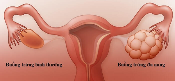 Buồng trứng đa nang là hội chứng liên quan đến nội tiết