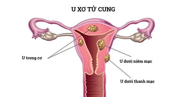 Phụ nữ trong độ tuổi sinh sản có nguy cơ cao mắc u xơ tử cung