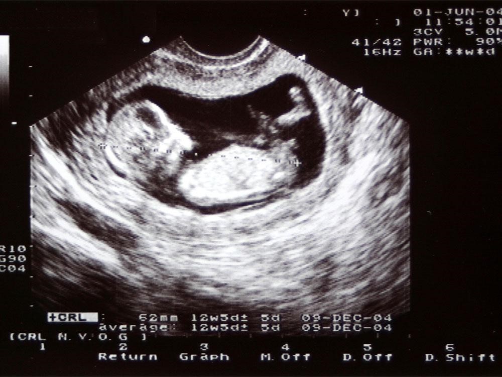 Hình siêu âm thai nhi ở tuần thai thứ 12