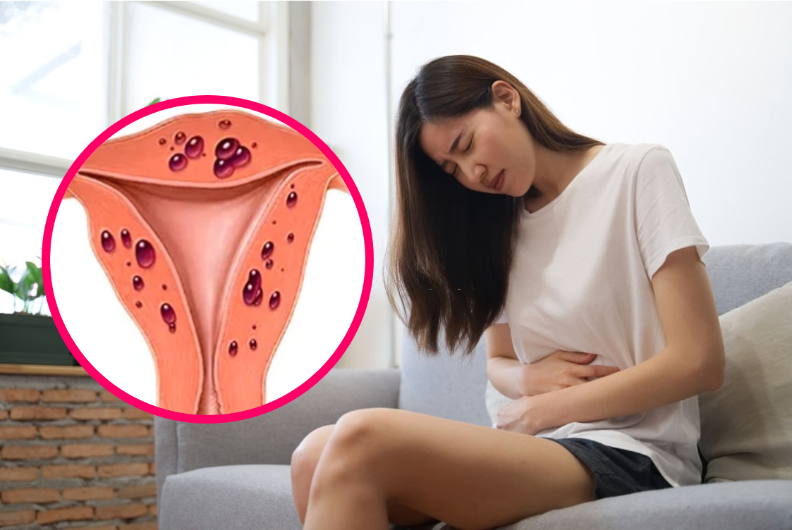 Lạc nội mạc tử cung gây đau bụng dữ dội trong kỳ hành kinh