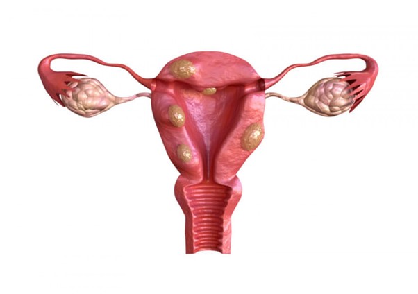 Hình ảnh minh họa u xơ tử cung