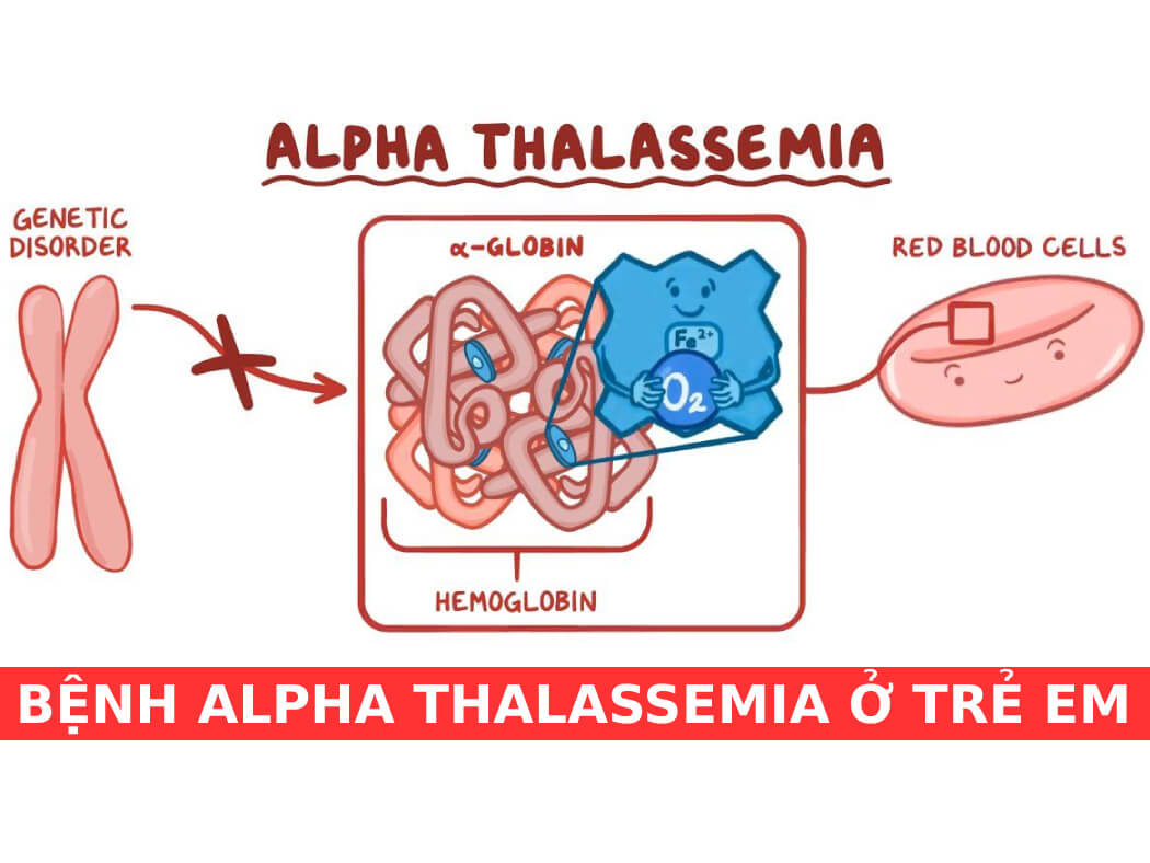 benh alpha thalassemia o tre em 1